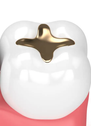 gold filling image