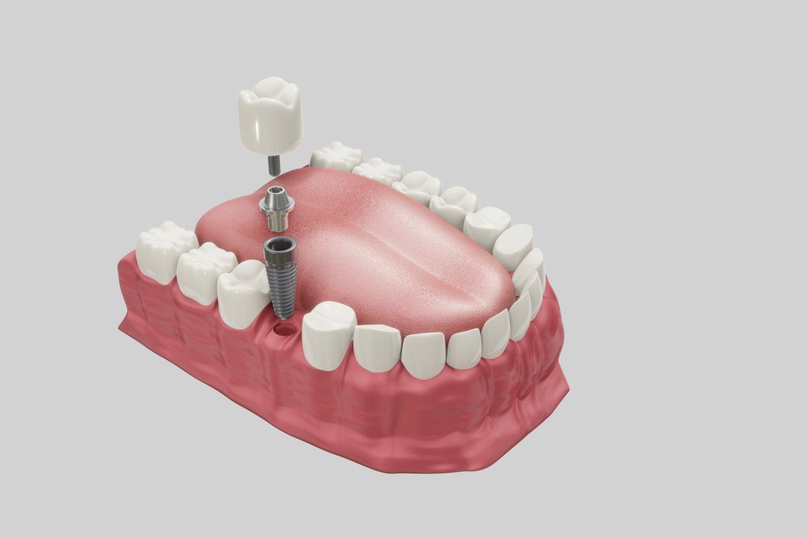 Dental Implant Procedure