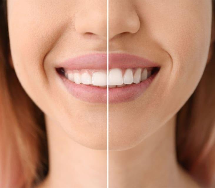 Laser Gum Treatment